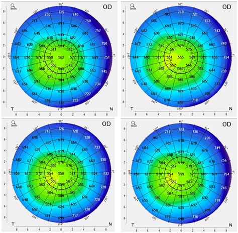 Pachymetry Conversion Chart Conversion Chart And Table Online