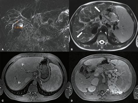 Scielo Brasil Prognostic Role Of Magnetic Resonance Imaging Of The