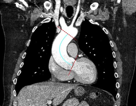 Ascending Aortic Length And Risk Of Aortic Adverse Events The