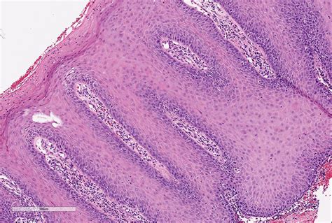 Verruca Histology