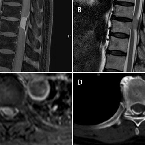 PDF Ossified Thoracic Spinal Meningioma With Lamellar Bone Formation