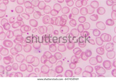 Hypochromia On Blood Smear Patient Thalassemia Stock Photo 647458969