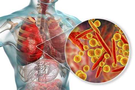 Mycoplasma Pneumoniae