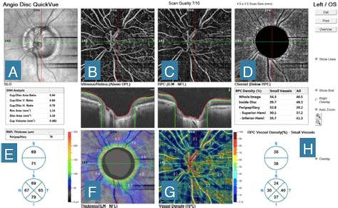 An Lisis De La Perfusi N Del Nervio Ptico Mediante El Uso De Angio Oct
