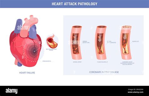 Patología De Un Ataque Al Corazón Y Ateroesclerosis Ilustración Médica