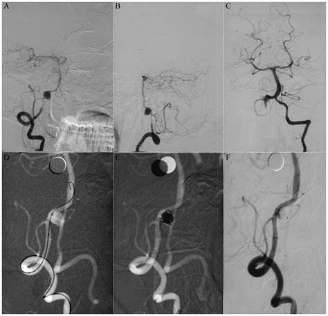 Endovascular Interventional Therapy And Classification Of Vertebral