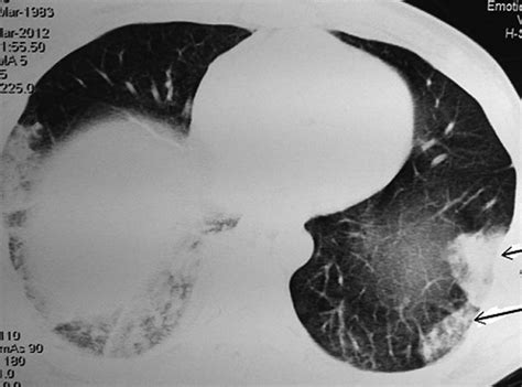 CT Chest Image Showing Wedge Shaped Ground Glass Opacities Suggestive