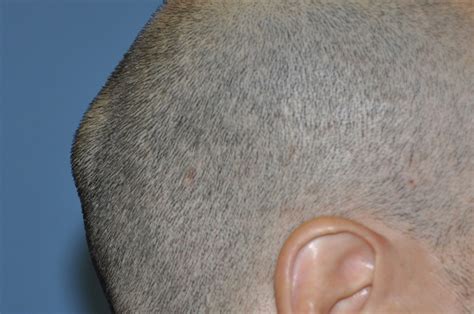 Bump On Back Of Head