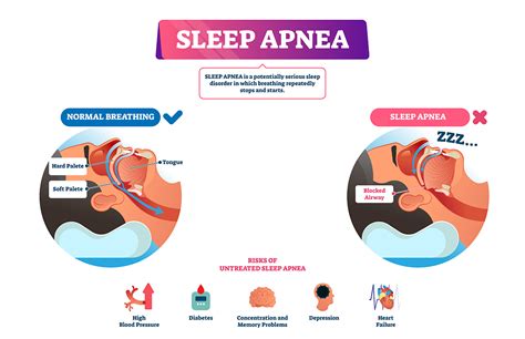 Sleep Apnea And Snoring Treatments Smile Angels Of Beverly Hills