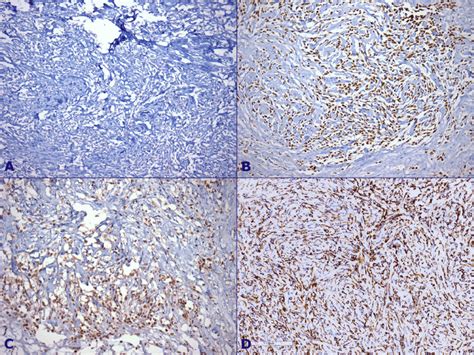 Photomicrography Of The Third Resected Tumor Immunohistochemistry