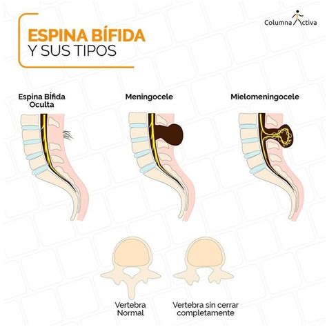 Espina bífida y sus tipos Espina bifida Músculos de espalda Músculo