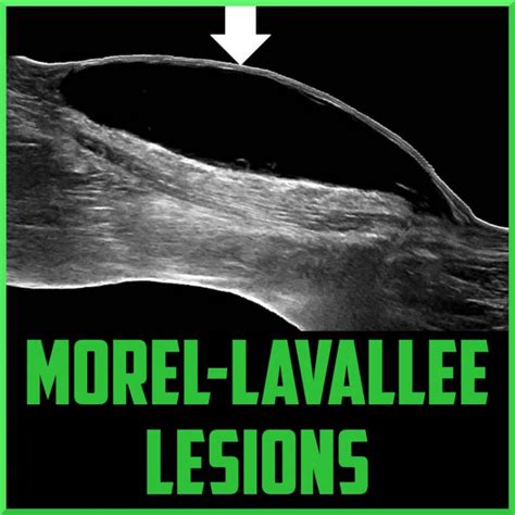 Morel-Lavallee lesions - Sports Medicine Review