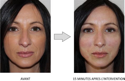 Rajeunissement Du Visage Fils Tenseurs Carr Esth Tique Lafayette