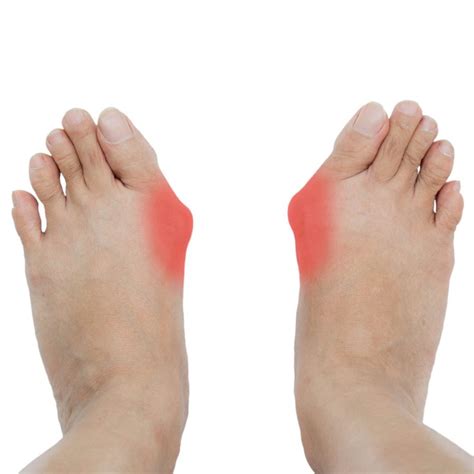 Hallux Valgus Beschwerden Behandlung