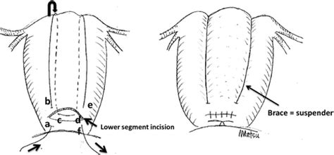 Uterine Compression Sutures For Postpartum Hemorrhage An Overview