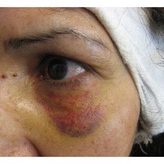 A Case With Severe Periorbital Ecchymosis And Mild Subconjunctival