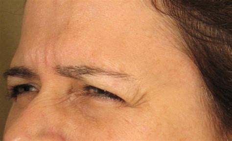 Botox Crows Feet Photo 1 Vita Laser Medical Spa In Queens NY