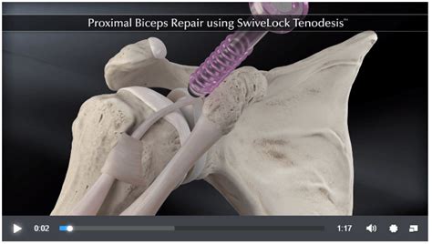 Arthroscopic Biceps Tenotomy Milwaukee Arthroscopic Biceps Tenodesis