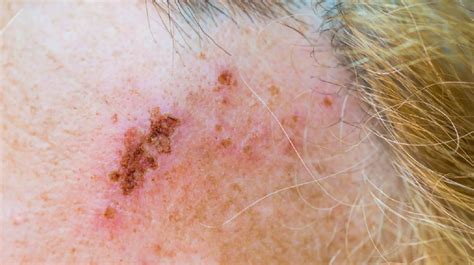 Beginning Stages Of Shingles On Neck