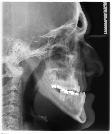 Improving Smiles With Orthognathic Surgery Shirley Ny