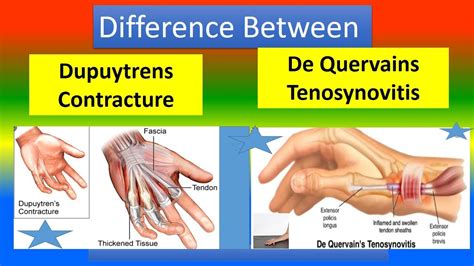 Difference Between Dupuytrens And De Quervains Conditions YouTube