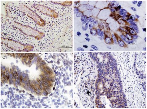 Rna Chromogenic In Situ Hybridization Of Mir 17 5p With Lna Ribo Probe