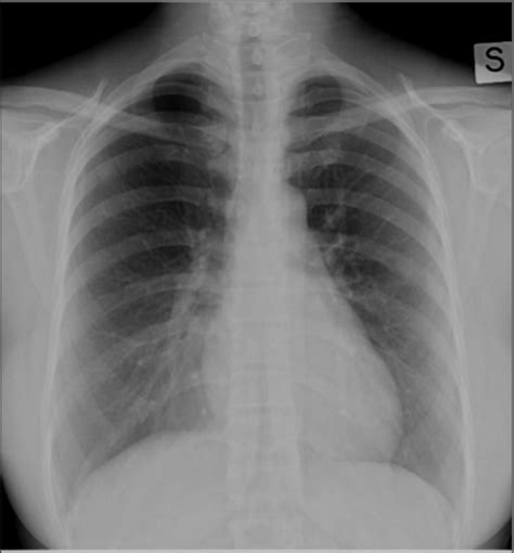 Normal Chest X Ray Showing Radiopaque Vascular Structures Branch Off