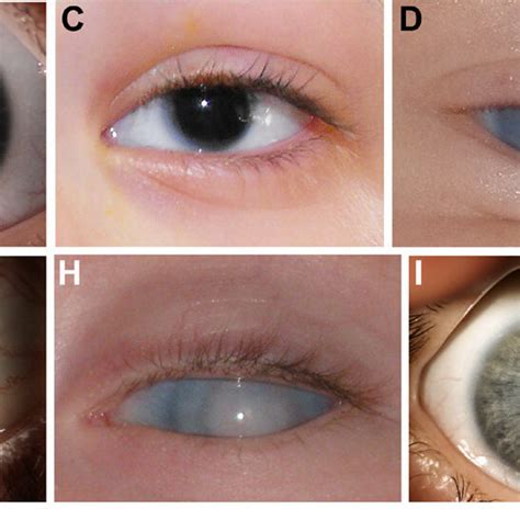 Clinical Images From Individuals With Pitx2 Related Ars And Download Scientific Diagram