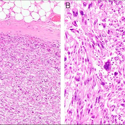 A Undifferentiated Pleomorphic Sarcoma Of The Pancreas Showing