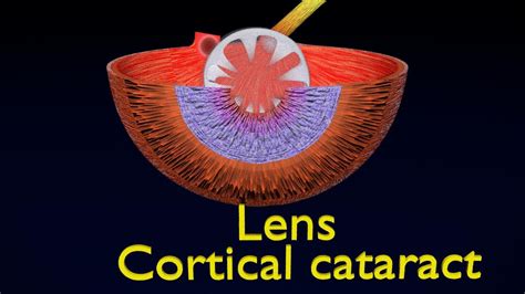 ArtStation - cataract types | Resources