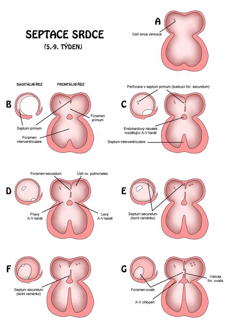 Interventricular Foramen Heart