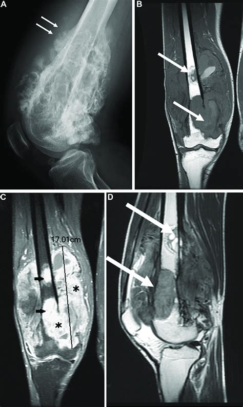 A 32 Year Old Man With Dedifferentiated Parosteal OGS At Right Distal