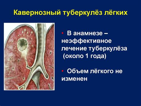 Деструктивные формы туберкулеза легких - презентация онлайн