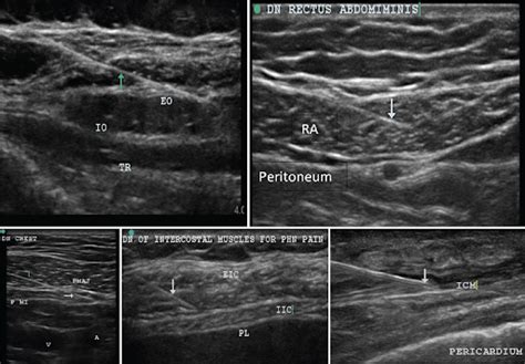 Ultrasound Guided Dry Needling Ashirvad