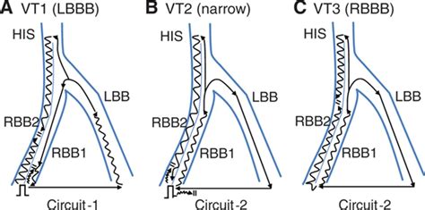 Bundle Branch Reentrant Ventricular Tachycardia With Wide And Narrow