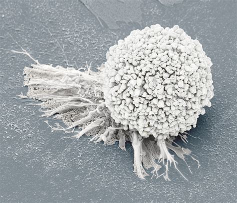 Cervical Cancer Cell SEM Stock Image C058 5979 Science Photo Library