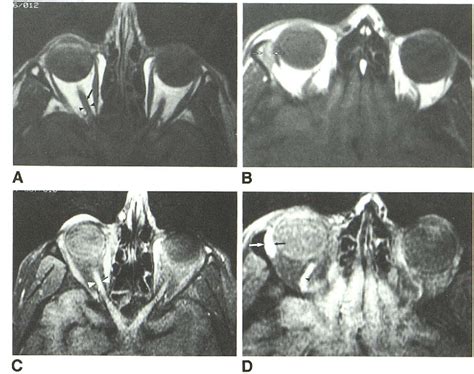 Figure From Fat Suppression Mr Imaging Of The Orbit Semantic Scholar