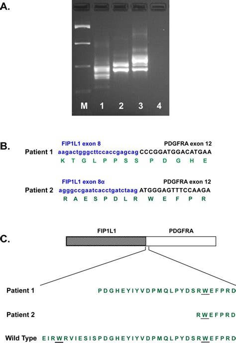 Fip1l1 Pdgfra Molecular Analysis In The Differential Diagnosis Of