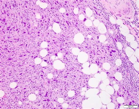 Pathology Outlines Pleomorphic Dermal Sarcoma