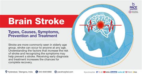 Brain Stroke: Types, Causes, Symptoms, Prevention and Treatment