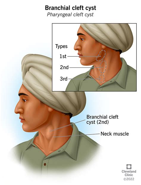 Branchial Cleft Cyst Types