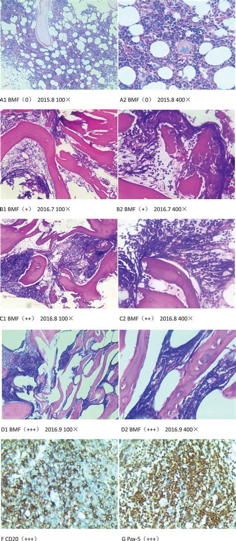 A D H E And Reticulin Stain Of Bone Marrow Fibrosis BMF