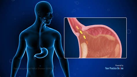 Gastroesophageal Reflux Disease