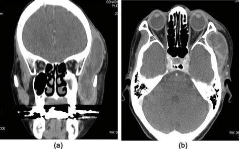 Ct Images Showed Low Density Area At The Left Side Of The Temporal Area