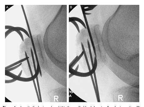 Figure 1 From Modified Tension Band Technique For Patella Fractures