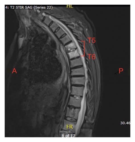 Mri Thoracic Spine With Findings Of Discitis Osteomyelitis Involving