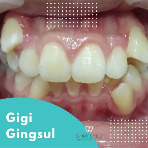 Gigi Gingsul Penyebab Dan Cara Mengatasinya