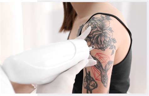 L Ser Para Eliminar Tatuajes En Qu Consiste Y C Mo Debes C