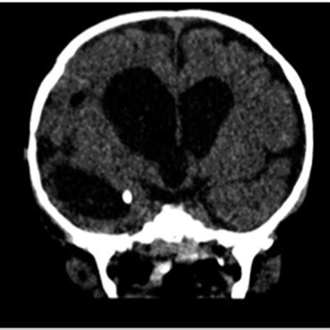 Ventriculoperitoneal shunt was inserted plus endoscopic fenestration of ...