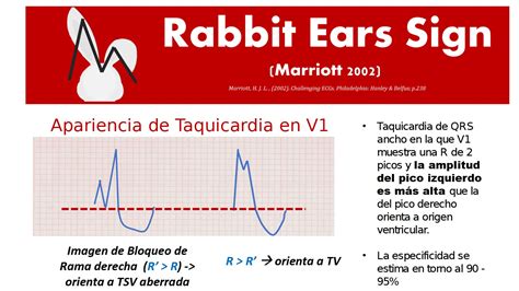 CardioTruco Signo De Marriott Cardioprimaria Ferrol